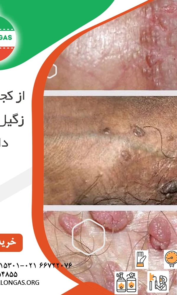 از کجا بفهمم زگیل تناسلی دارم