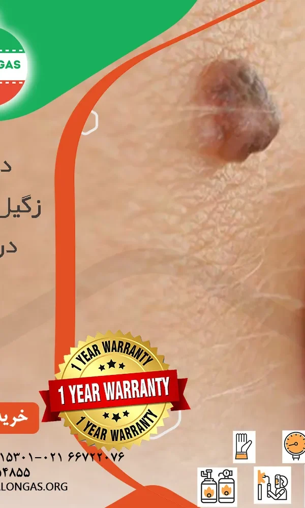 بالن درمان زگیل تناسلی در خانه