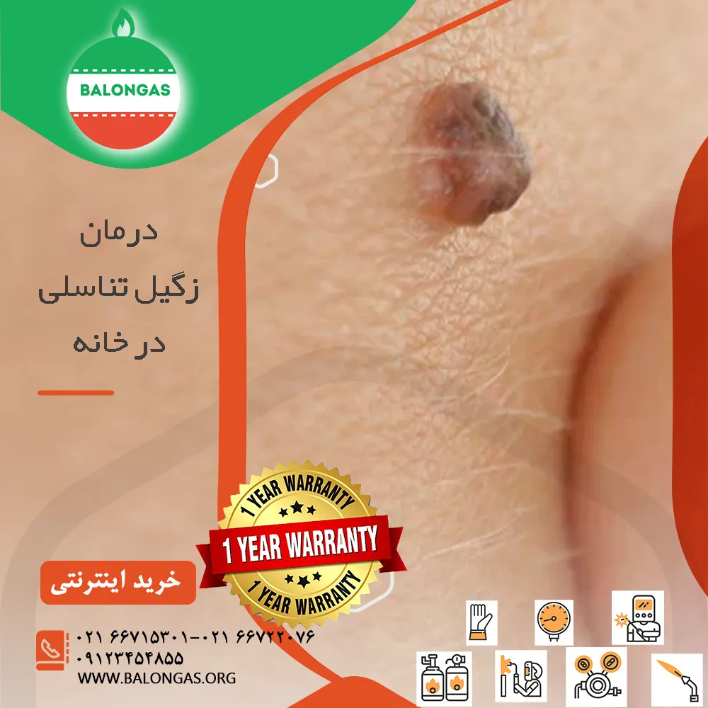 بالن درمان زگیل تناسلی در خانه